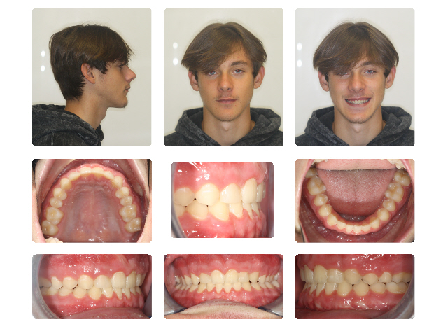 after braces