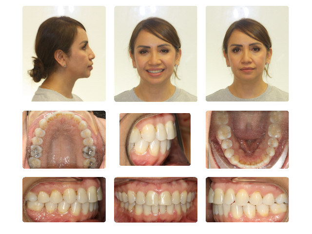after invisalign