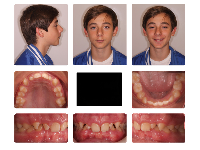 before braces