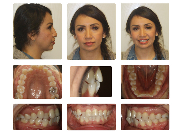before invisalign